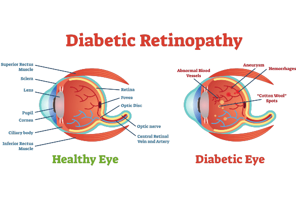 Diabetic Eye Examination